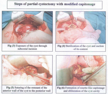 Evaluation of different surgical techniques in treatment of cystic hydatid disease of the liver